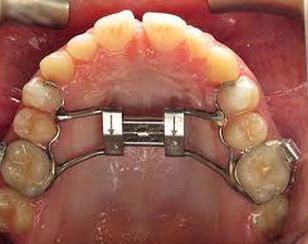 Rapid Palatal Expander